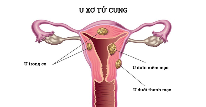 Cựu thành viên T-ara bất ngờ phát hiện khối u tử cung, liệu có nguy hiểm?