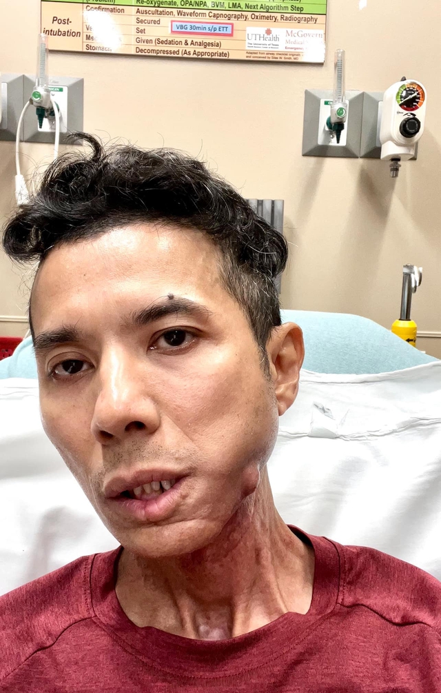 Năm 2023, Kasim Hoàng Vũ công khai thông tin mắc bệnh viêm khớp xương hàm và phải phẫu thuật nang xương ở hàm và cổ (ảnh: FB)