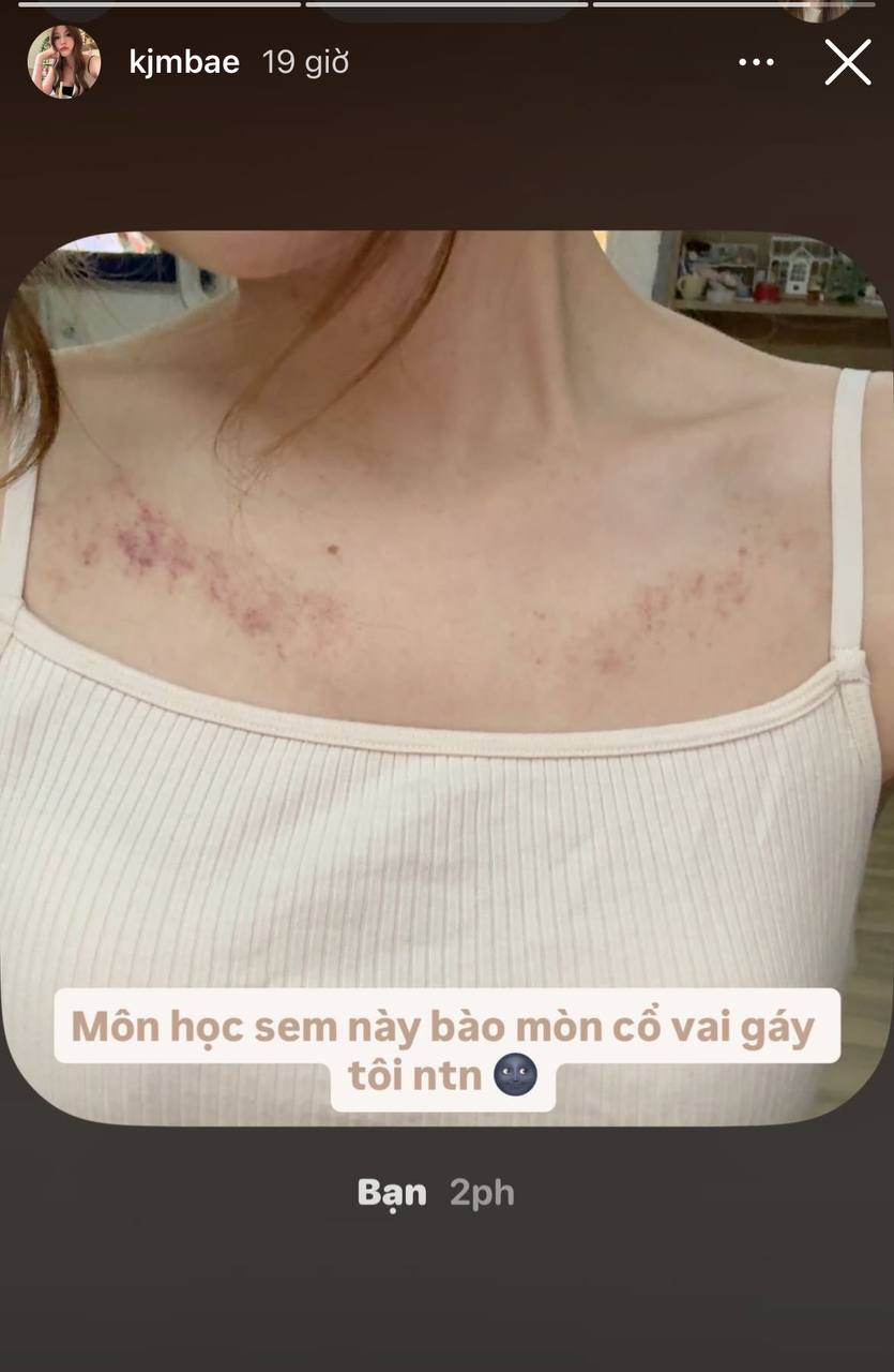 Tăng Mỹ Hàn cập nhật hình ảnh cổ vai gáy khiến nghi ngờ càng thêm có cơ sở