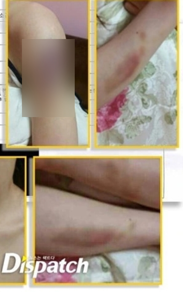 Choi Hye Mi tung ảnh bị thương tích trong cáo buộc chống lại Kim Hyun Joong. Ảnh: Naver