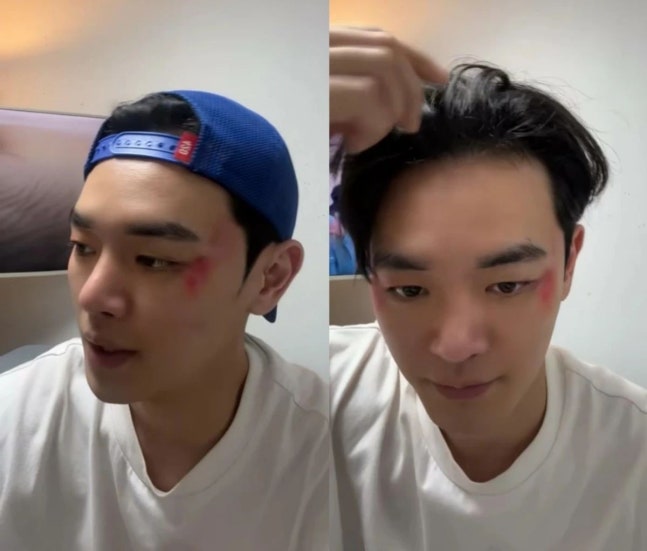 Jang Dong Joo xuất hiện với gương mặt thâm tím, nói rằng do chủ nợ gây ra. Ảnh: Koreaboo