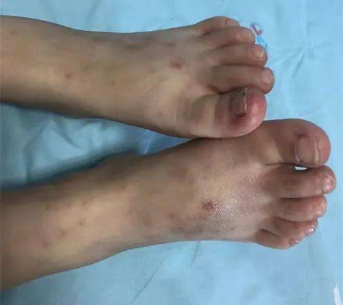 Bé gái 10 tuổi mắc bệnh gút (Ảnh minh họa)