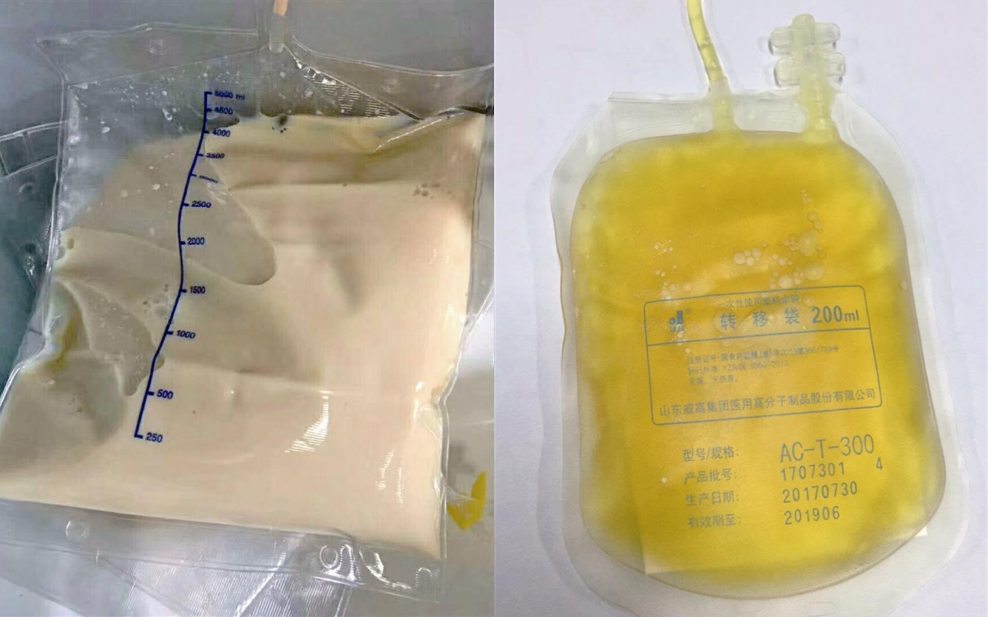 Máu của cô gái 27 tuổi có màu trắng đục như trà sữa vì viêm tụy cấp