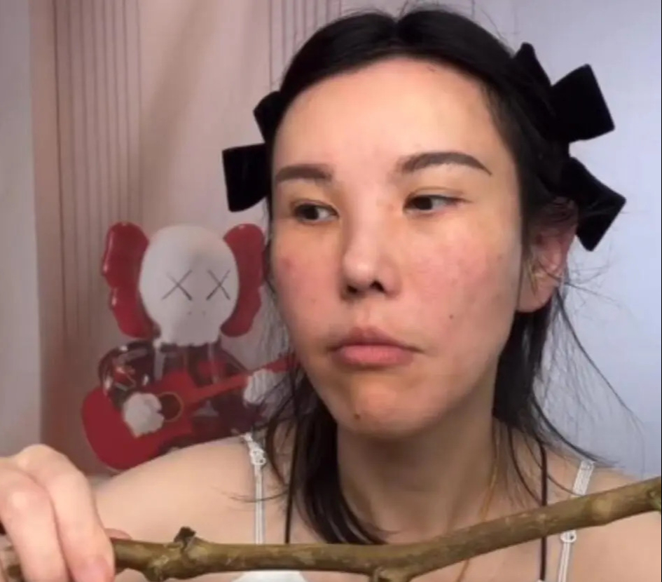Khuôn mặt biến dạng của Tiểu Yến sau 2 năm làm mukbang