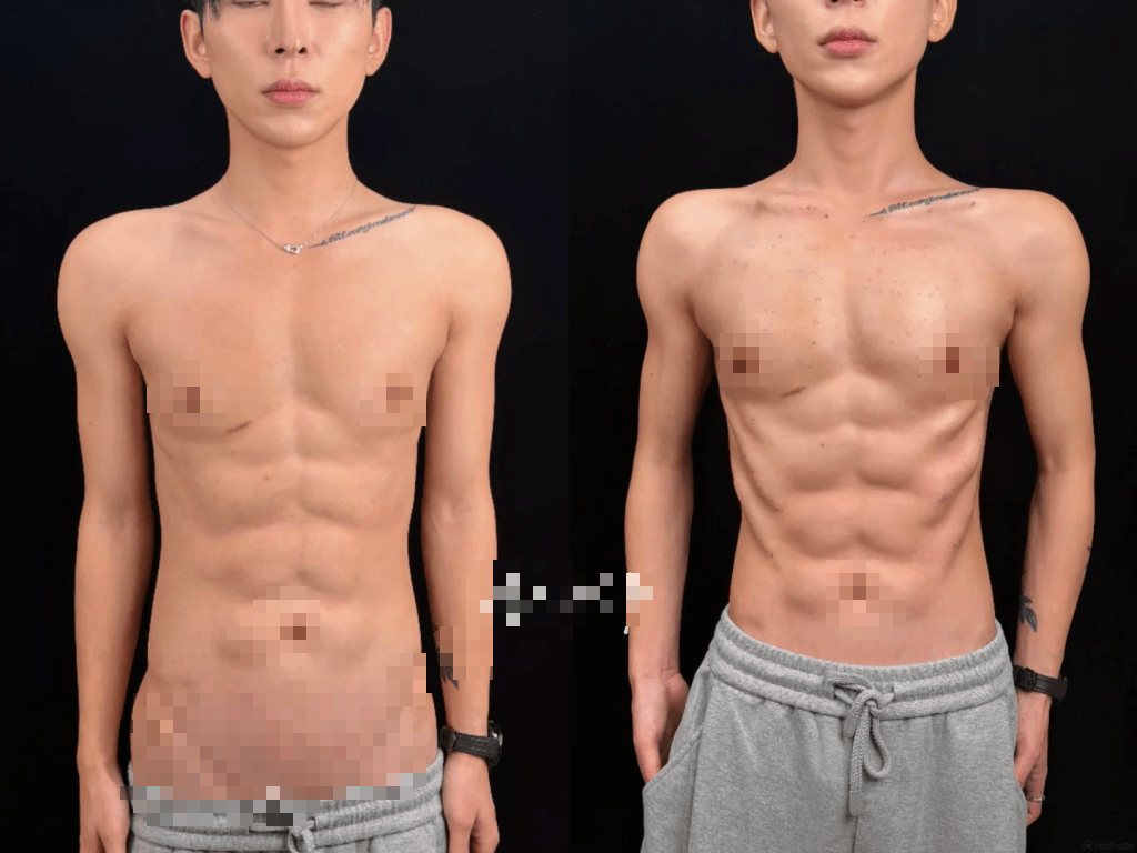 Nam Tiktoker không ngại chi món tiền khủng để tiêm chất làm đầy tạo hình cơ thể săn chắc, gợi cảm