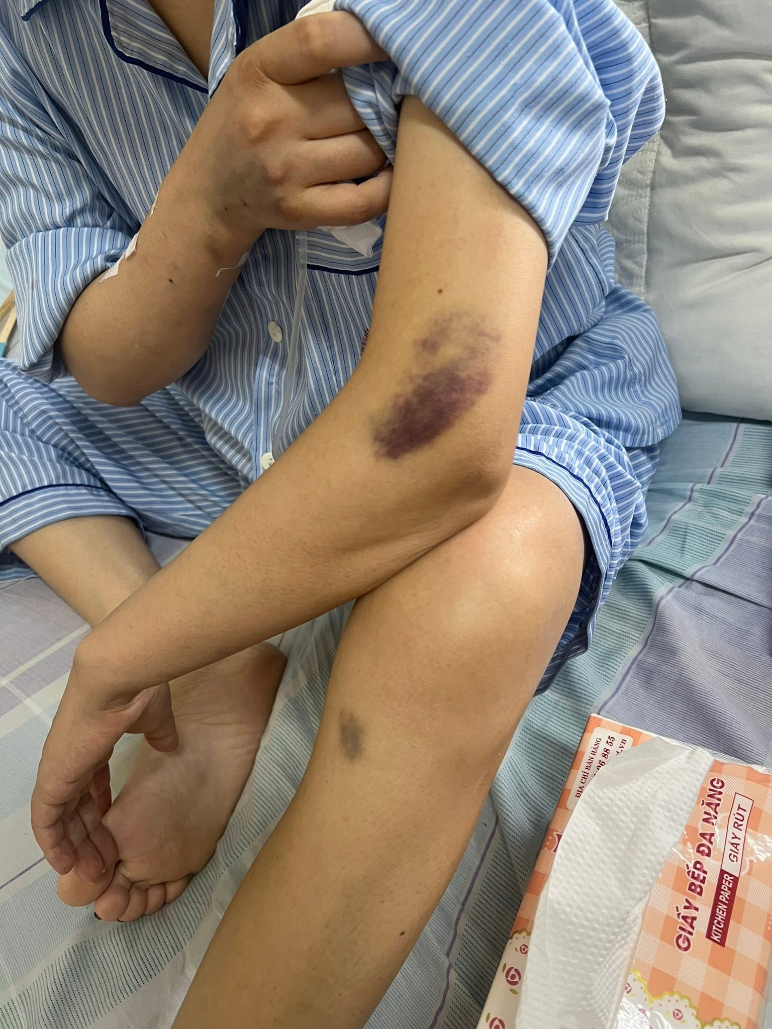 Trong quá trình chữa bệnh, tay chân Mai có lúc bị bầm tím, có lúc bị tác dụng phụ của thuốc