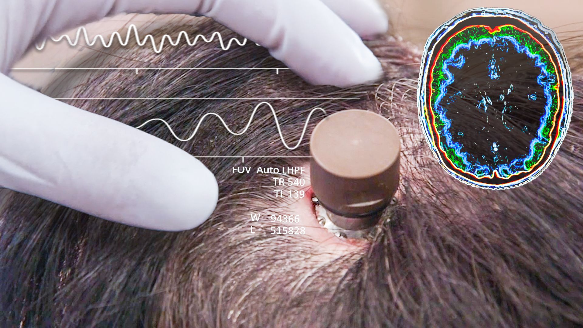 Công ty công nghệ thần kinh của Elon Musk có tên Neuralink đang tiếp tục thử nghiệm cấy ghép chip vào não người để phục hồi các chức năng cơ thể (Ảnh: BBC)