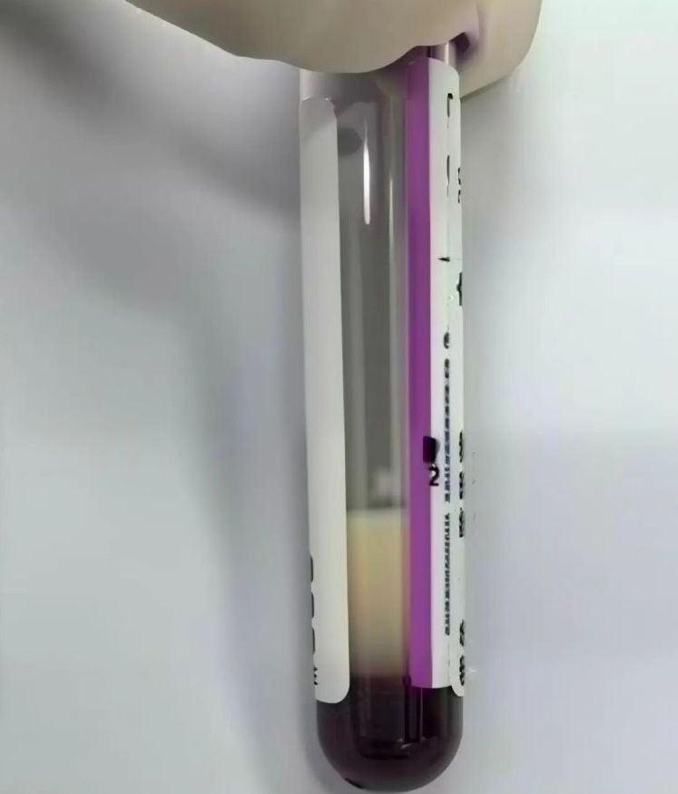Máu của cô Yang có lượng mỡ gấp 118 lần giới hạn bình thường (Ảnh từ BV)