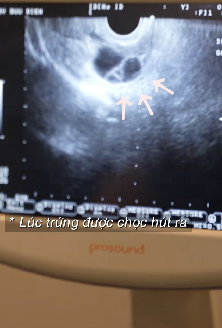 Chi 40 - 60 triệu trữ trứng: Câu chuyện của hai cô gái tuổi 30 có kinh tế, đợi đúng người tinh tế