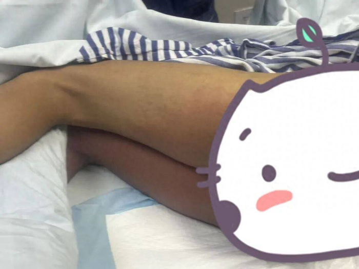 Tình trạng làn da của Tiểu Minh khi nhập viện cấp cứu (Ảnh từ BV)