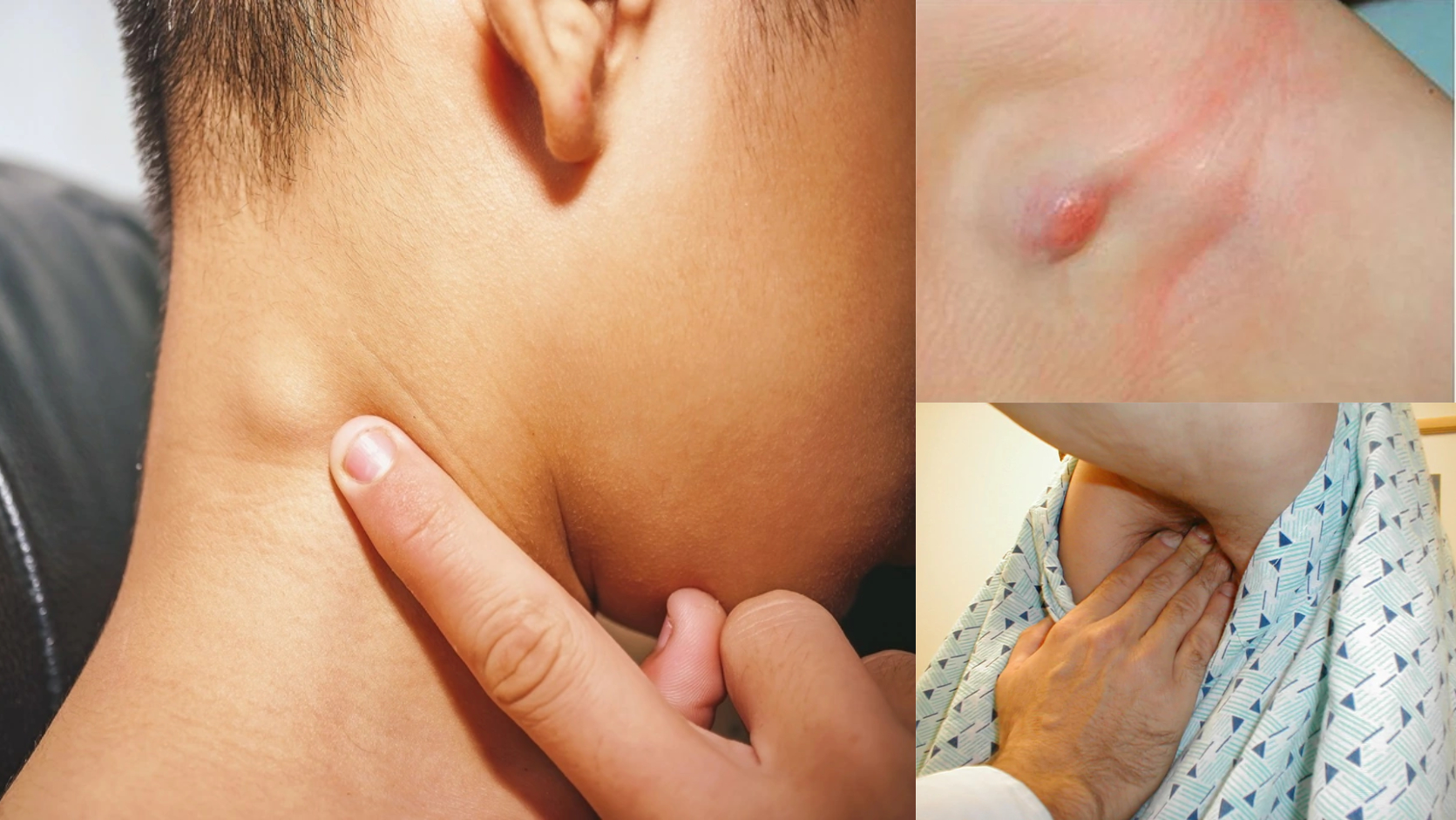 Tuyệt đối không được chủ quan với các nốt hạch bất thường ở cổ, nách hay vùng bẹn