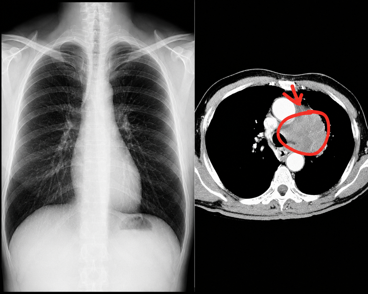 Sự khác biệt giữa kết quả chụp X-quang và chụp CT tại phổi của cô Lưu (Ảnh từ Bs)