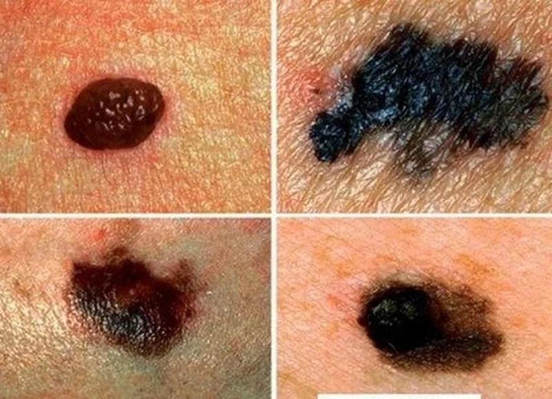 Không nên tự ý đốt nốt ruồi và đến bệnh viện ngay khi chúng có thay đổi về kích thước, màu sắc hay bị viêm loét (Ảnh minh họa)