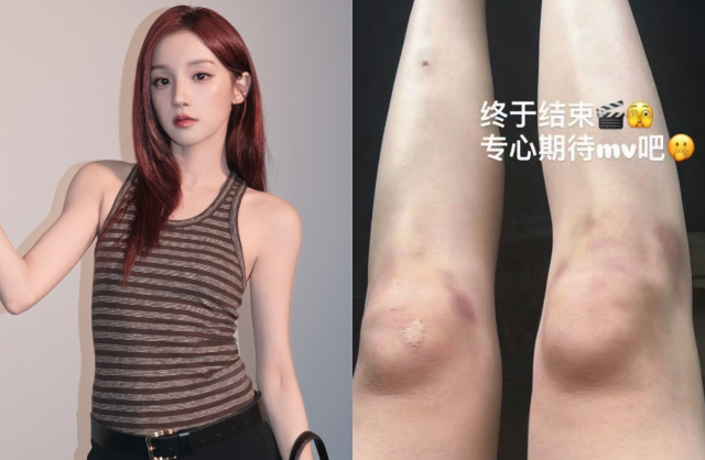 Tống Vũ Kỳ chia sẻ hình ảnh đôi chân thương tích, chi chít vết bầm vì tập luyện cường độ cao trong suốt chín ngày liên tiếp để chuẩn bị cho MV mới. Cô cũng đã tái phát chấn thương chân. Ảnh: Weibo.