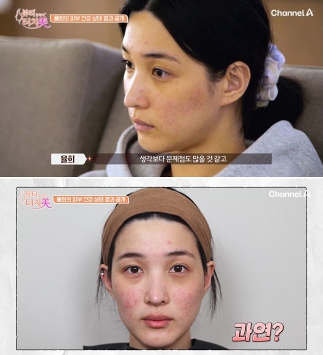 Chương trình Beauty Clinic Touch Me vừa công bố mặt mộc tàn tạ gây sốc của Yulhee. Ảnh: Naver