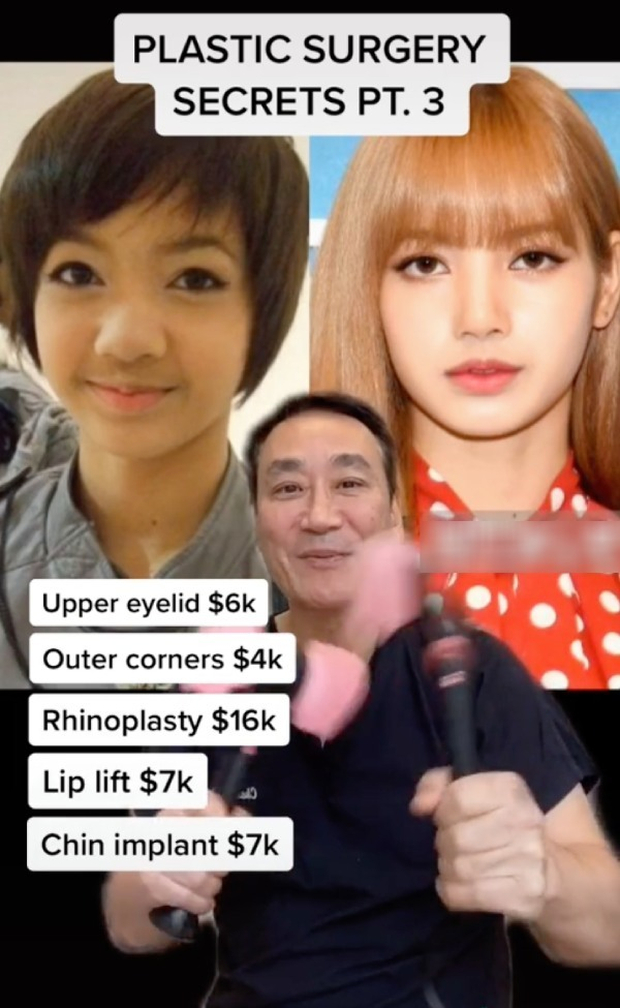 Trước đó, 1 bác sĩ thẩm mỹ nổi tiếng đăng ảnh ngày ấy - bây giờ của Lisa, đồng thời tố nữ idol “dao kéo” khắp mặt. Ảnh: Koreaboo