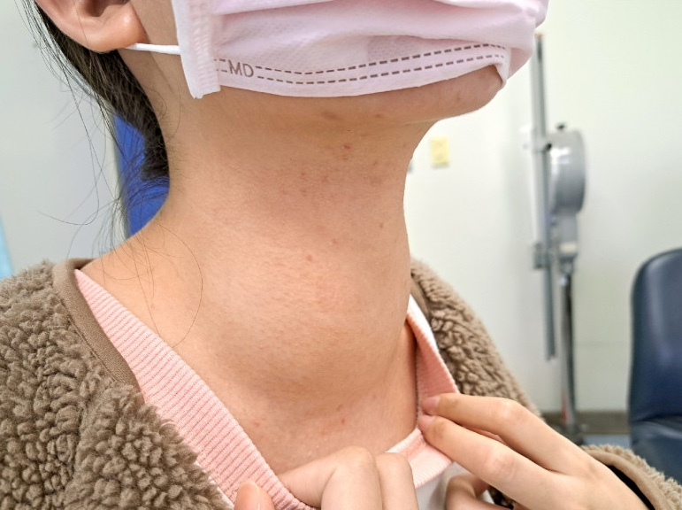 Một số dấu hiệu rõ ràng nhất của ung thư tuyến giáp là cổ dày lên, có khối u và gây khó nuốt (Ảnh minh họa)