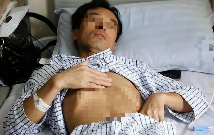Người đàn ông phát hiện ung thư gan giai đoạn 3 sau khi ngất xỉu vì đau bụng (Ảnh minh họa)