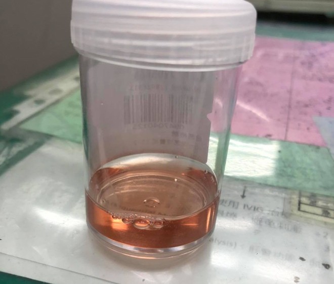 Tuyệt đối không xem nhẹ các bất thường trong nước tiểu, nhất là nước tiểu có máu (Ảnh minh họa)