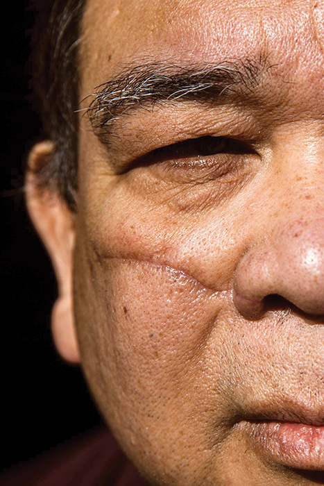 Vết sẹo trên mặt Noel Quintana, 61 tuổi người Philippines, sau khi bị kẻ lạ mặt dùng dao rạch trên đường đi làm. Ông cho biết: 