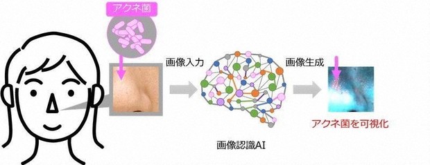  Hình ảnh từ Lion Corp cho thấy công nghệ giúp hình dung vi khuẩn Cutibacteria Acnes chịu trách nhiệm gây ra mụn trứng cá.