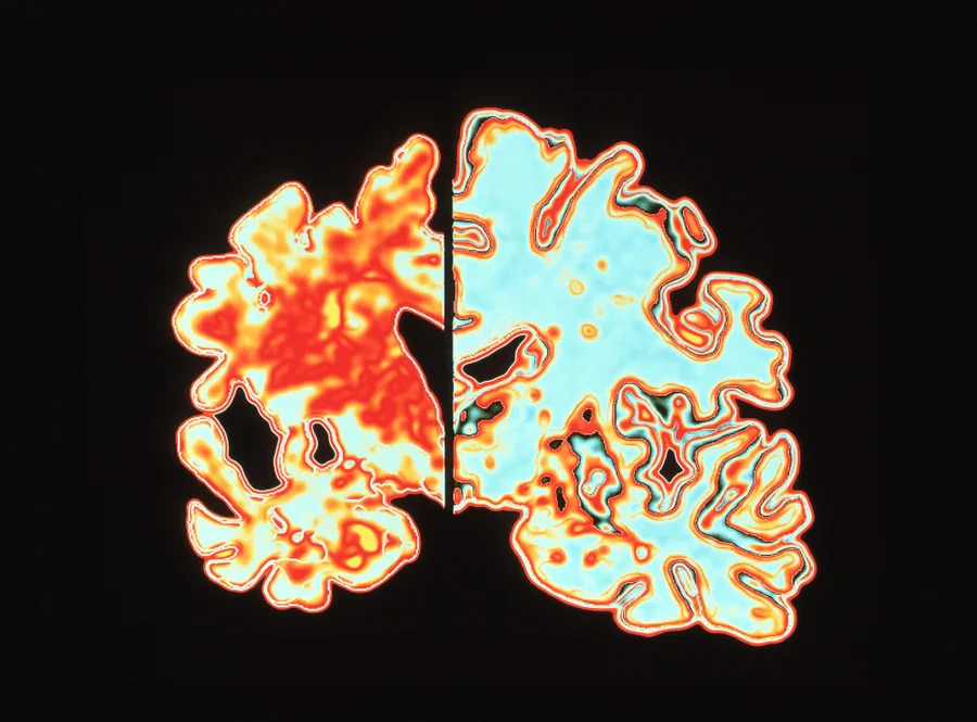 Hình đồ họa lát cắt dọc qua não của bệnh nhân Alzheimer (bên trái) so với não bình thường (bên phải)