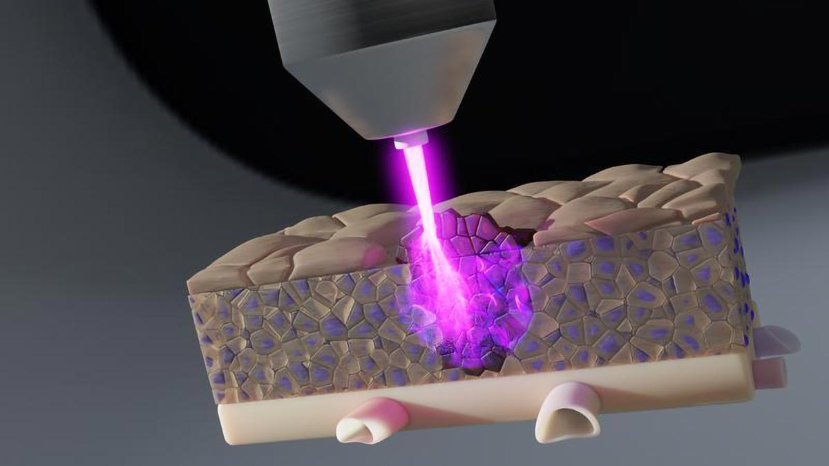 Tia plasma lạnh mở ra những khả năng thú vị cho các phương pháp điều trị ung thư trong tương lai.