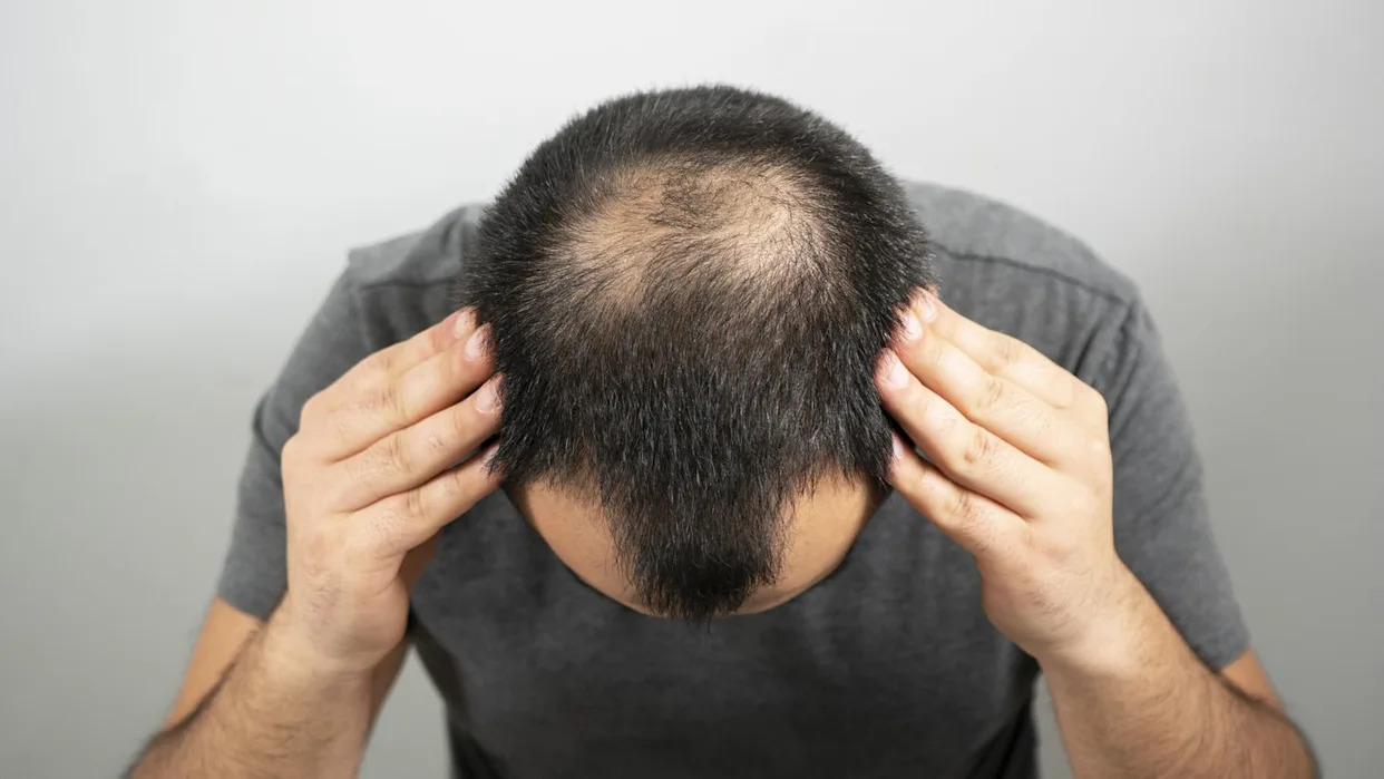 Phát hiện loại đường tự nhiên giúp kích thích mọc tóc mà không gây tác dụng phụ