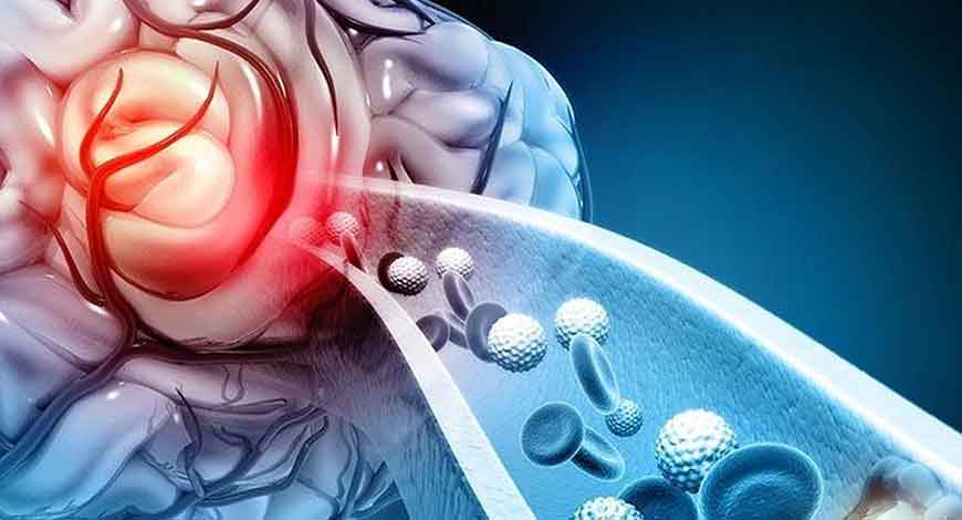 Đột phá liệu pháp nano giúp giảm tổn thương não sau đột quỵ