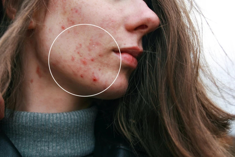 Công nghệ miếng dán vi kim mở hướng mới trong điều trị mụn trứng cá