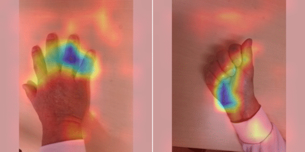 AI chẩn đoán chính xác chỉ qua hình ảnh mu bàn tay và bàn tay khi đang nắm chặt