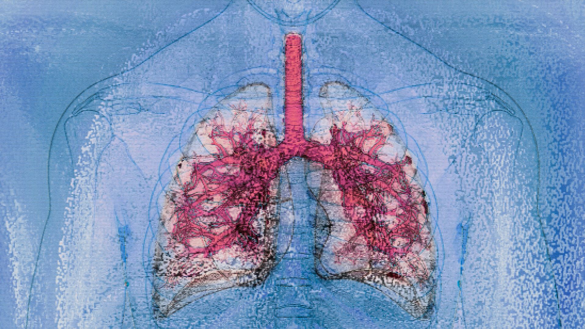 Mỹ thực hiện thành công ca ghép đa tạng từ người nhiễm HIV sang người nhiễm HIV đầu tiên trên thế giới