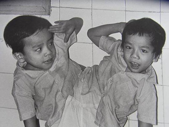 30 năm trước, cặp song sinh Việt- Đức đã đánh dấu cho sự phát triển vượt bậc của ngành Y Việt Nam