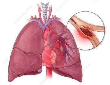 Hình ảnh minh hoạ thuyên tắc phổi. Ảnh: Sciencephoto
