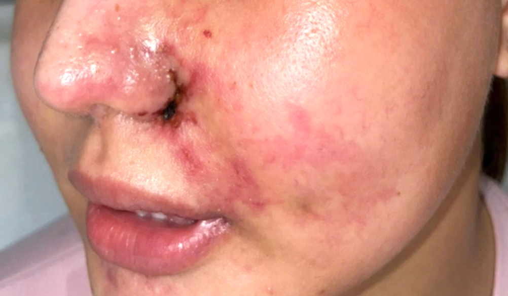 Một trường hợp bị biến chứng sau làm đẹp.