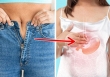 Chứng trào ngược dạ dày sẽ trở nên tồi tệ hơn, nếu bạn không bỏ 5 thói quen này