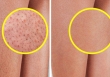 7 mẹo đơn giản hỗ trợ làn da bị viêm nang lông 