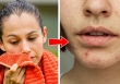 Vị trí của mụn trứng cá trên cơ thể nói lên điều gì?