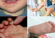 1 trường hợp tử vong nghi do bệnh tay chân miệng, Bộ Y tế khuyến cáo phòng chống bệnh