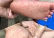 TP.HCM lo thiếu thuốc điều trị tay chân miệng nặng, Bộ Y tế nói gì?