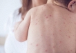Dấu hiệu giảm tiểu cầu khi bị sốt xuất huyết không thể xem thường