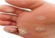 8 giải pháp tốt nhất để trị mụn cóc, bạn đã làm thử chưa?