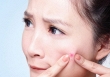 Mẹo chăm sóc da đúng cách sau khi nặn mụn