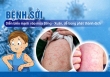 Thủ tướng ký ban hành Công điện yêu cầu tăng cường phòng, chống bệnh sởi