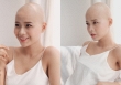 Hành trình chiến đấu với bệnh ung thư của nữ sinh 20 tuổi ĐH Ngoại thương
