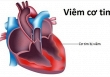 Thực hư virus viêm cơ tim gây chết người đang xôn xao cộng đồng mạng