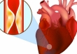 Cảnh báo cho người dưới 35 tuổi: Nhồi máu cơ tim ngày càng trẻ hóa