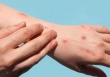 Những đối tượng nào cần tiêm chủng vaccine đậu mùa khỉ?