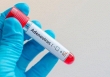 Khi nào cần xét nghiệm Adenovirus?