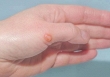 Virus đậu mùa khỉ đang tiến hóa?